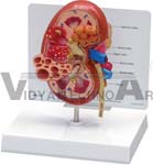 Oversize Diseased Kidney Anatomy Model with Patient Education Card